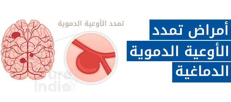 توسع الاوعية الدموية